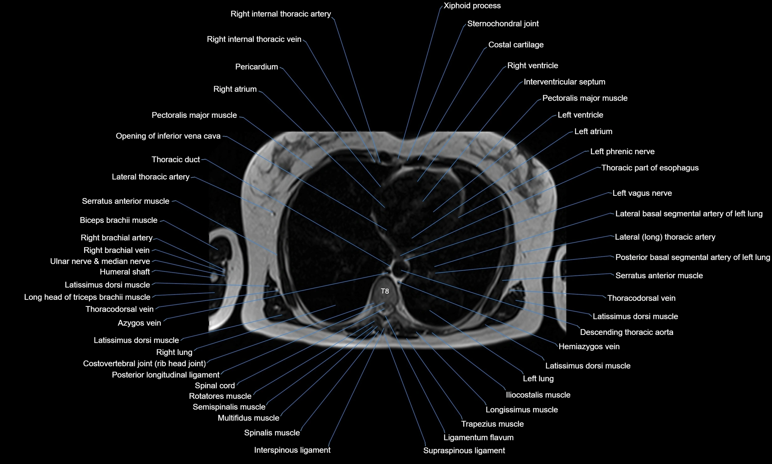 MRI chest axial  cross sectional anatomy 3T radiology  image-img-00001-00028.webp